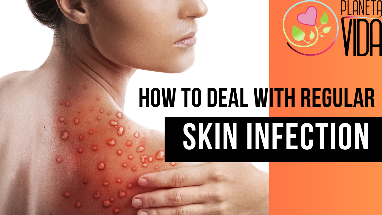 Q51 - How to Deal with Regular Skin Infections - EN